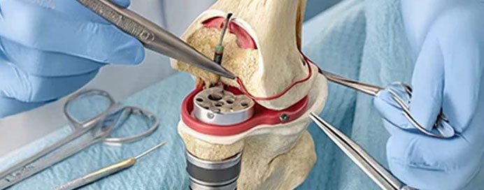 Knee Replacement (Robotic & Conventional)
