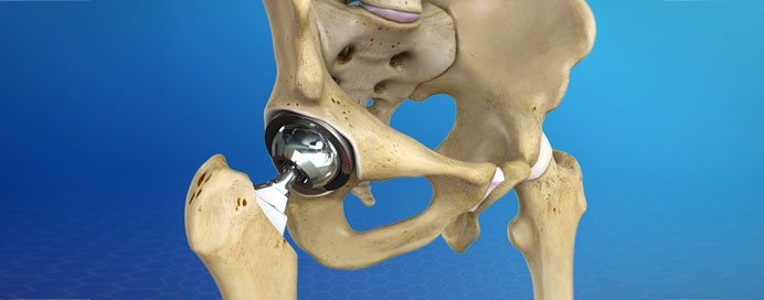 Hip Replacement
